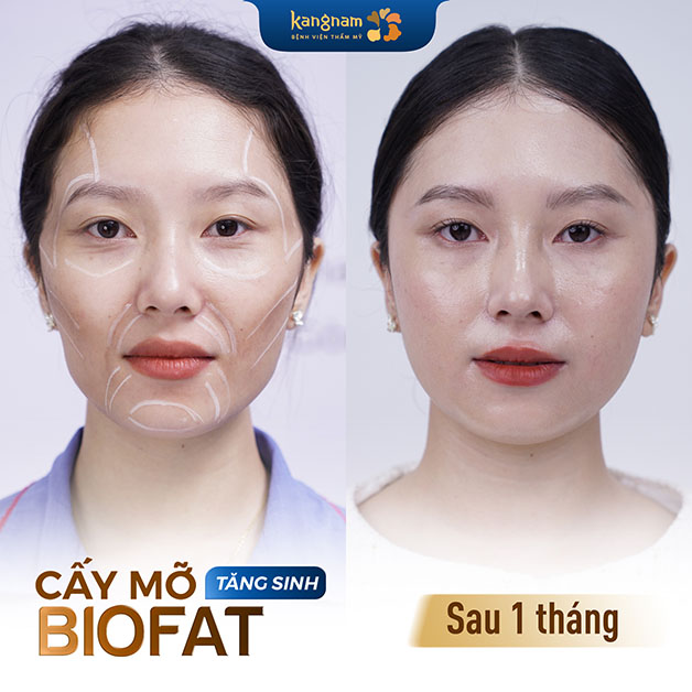 Cấy mỡ tăng sinh BioFat duy trì kết quả lâu dài