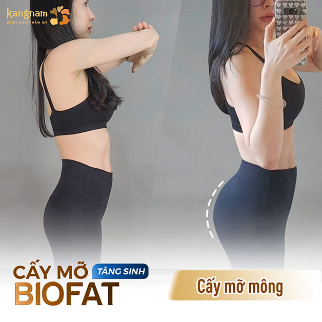 Cấy mỡ mông bền đẹp, chi phí hợp lý