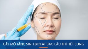 Cấy mỡ tăng sinh BioFat bao lâu thì hết sưng?