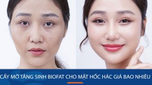 Cấy mỡ tăng sinh BioFat cho mặt hốc hác giá bao nhiêu?