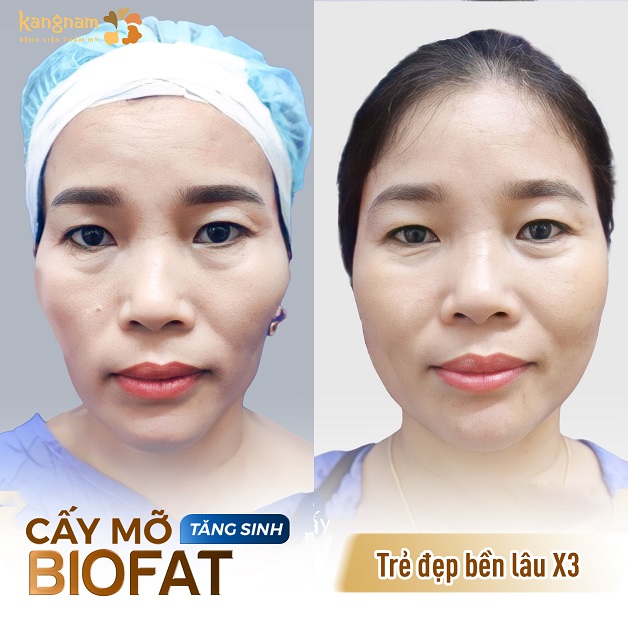 Cấy mỡ BioFat tăng sinh khắc phục khuyết điểm gương mặt hốc hác, thiếu sức sống