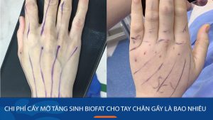 Chi phí cấy mỡ tăng sinh BioFat cho tay chân gầy là bao nhiêu?