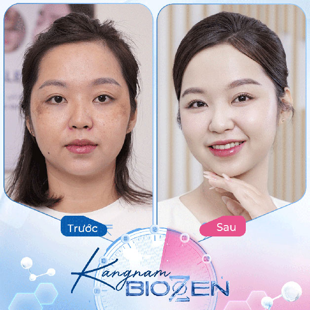 Tình trạng da bị nám, không đều màu sau điều trị Kangnam Biozen đã sáng mịn, đều màu hơn