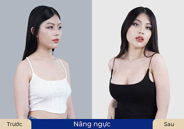 Sở hữu vòng 1 cân đối với dịch vụ nâng ngực