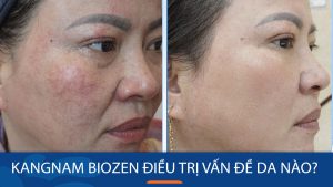 Kangnam Biozen có thể điều trị những vấn đề da nào?