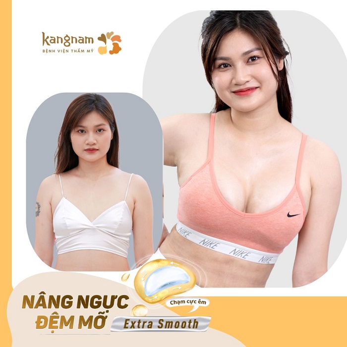 Công nghệ nâng ngực đệm mỡ Extra Smooth