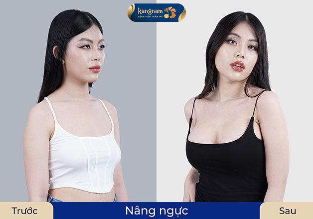 Mai Thy trước và sau khi nâng cấp vòng 1 bằng phương pháp nâng ngực đệm mỡ Extra Smooth