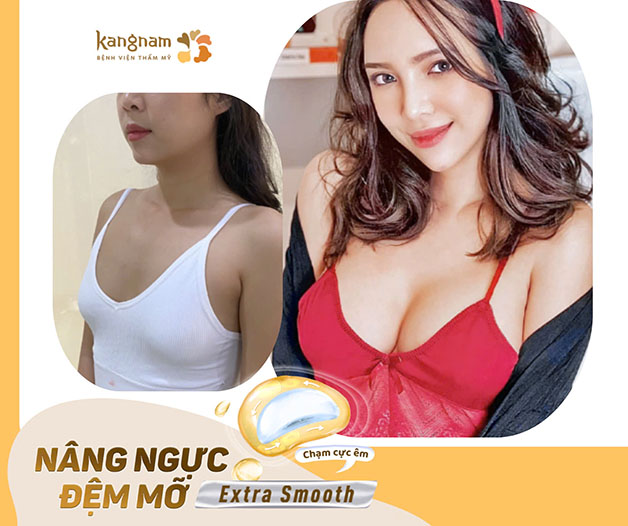 Nâng ngực đệm mỡ Extra Smooth là xu thế thẩm mỹ hiện đại