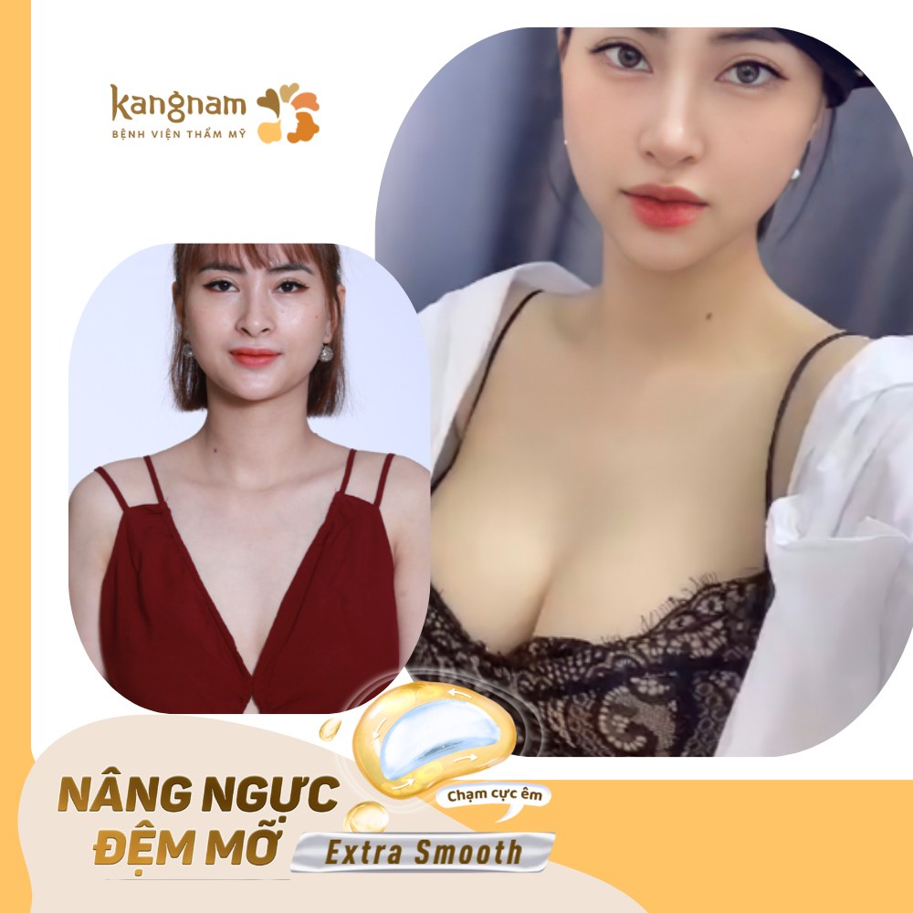 Chị em nên kiêng cữ khoảng 4 tuần sau nâng ngực đệm mỡ Extra Smooth 