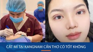 Cắt mí tại Kangnam Cần Thơ có tốt không?