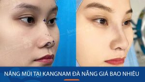 Nâng mũi tại Kangnam Đà Nẵng giá bao nhiêu?