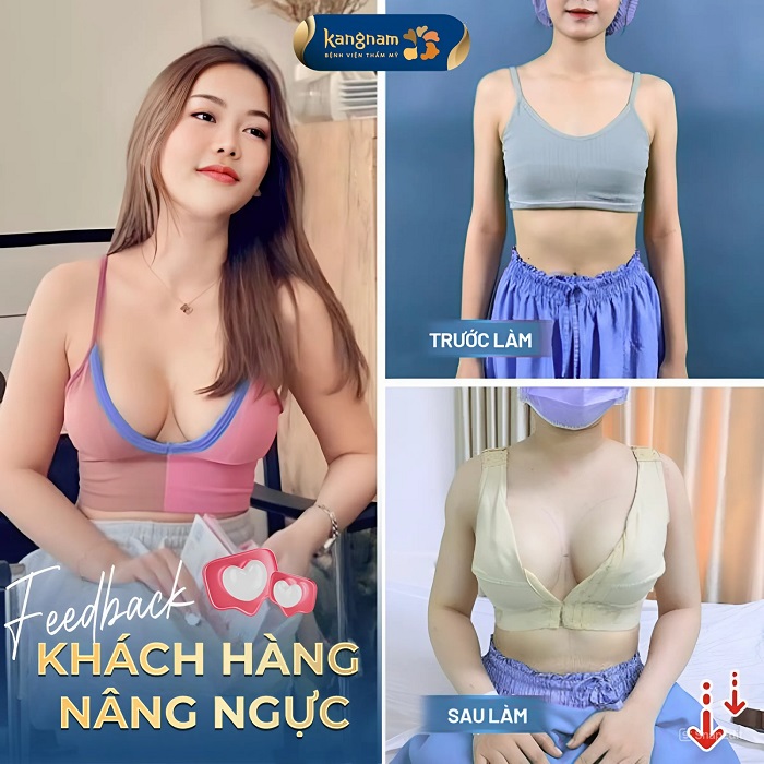 Vòng 1 to tròn, săn chắc và cân đối sau khi nâng ngực