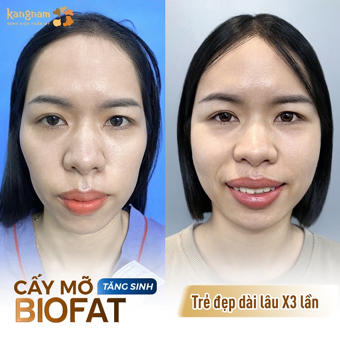 Gương mặt đầy đặn, tươi trẻ của khách hàng sau khi cấy mỡ mặt BioFat tăng sinh