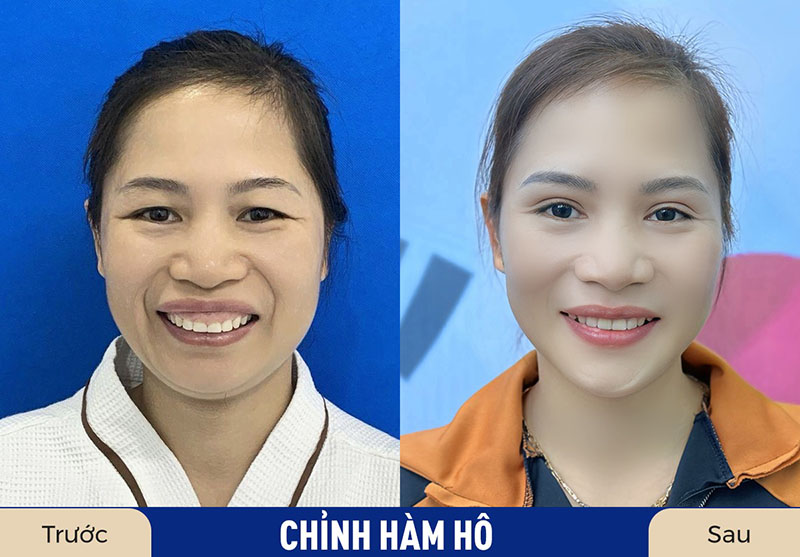 Chỉnh hàm hô có thể duy trì kết quả trọn đời