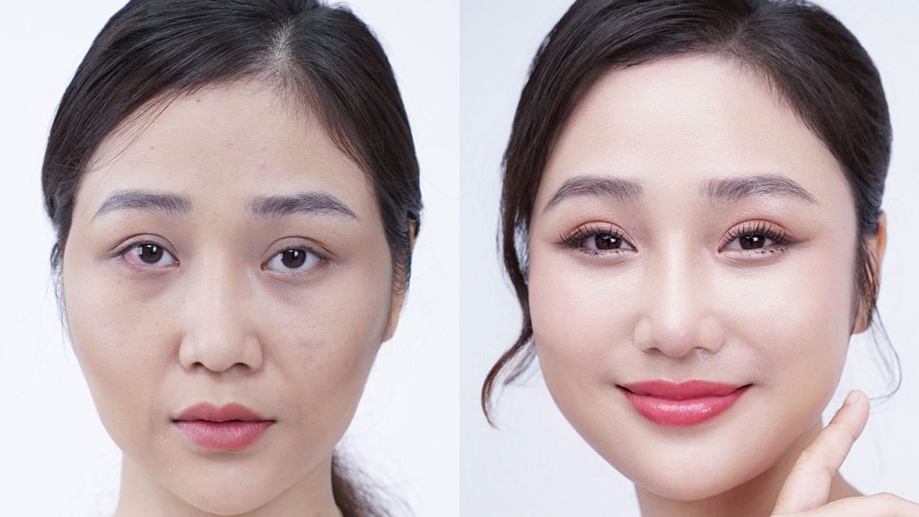 3 câu hỏi về cấy mỡ được quan tâm nhất