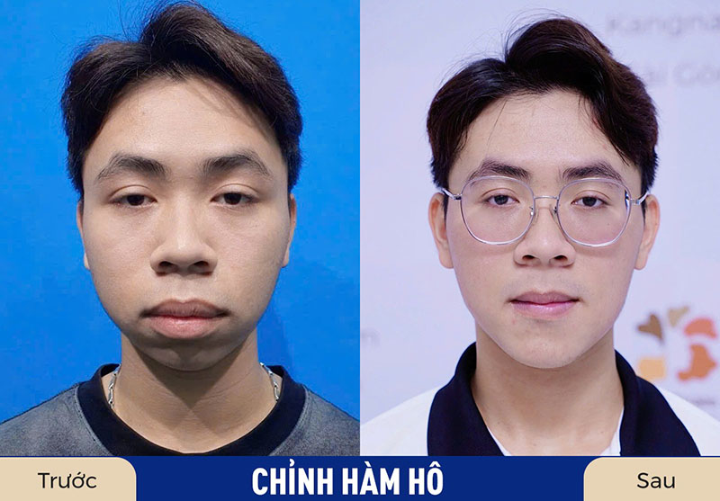 Sau khi chỉnh hàm hô, cấu trúc gương mặt ổn định và duy trì vĩnh viễn