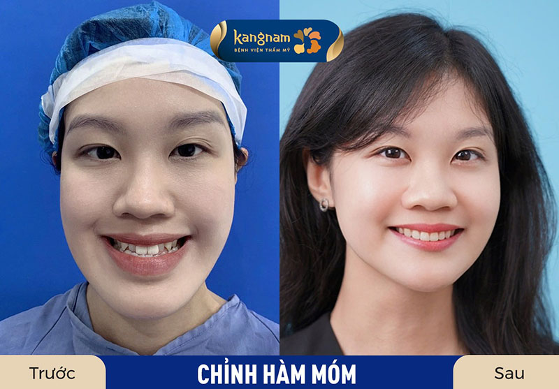 Chỉnh hàm móm giúp gương mặt cân đối, nụ cười đẹp hơn