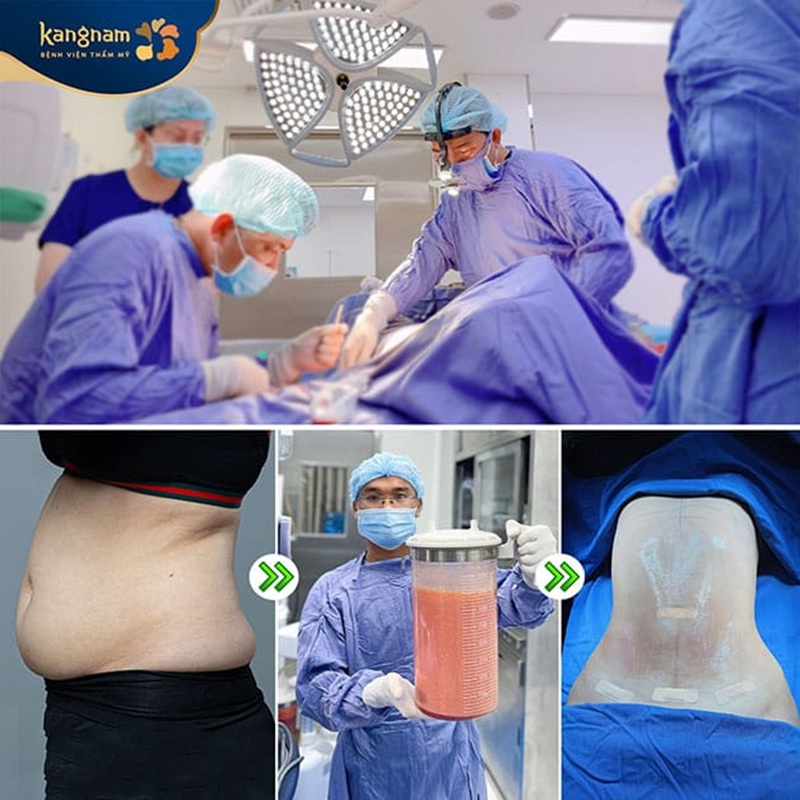 Đau sau hút mỡ là phản ứng của cơ thể và sẽ tự thuyên giảm sau vài ngày