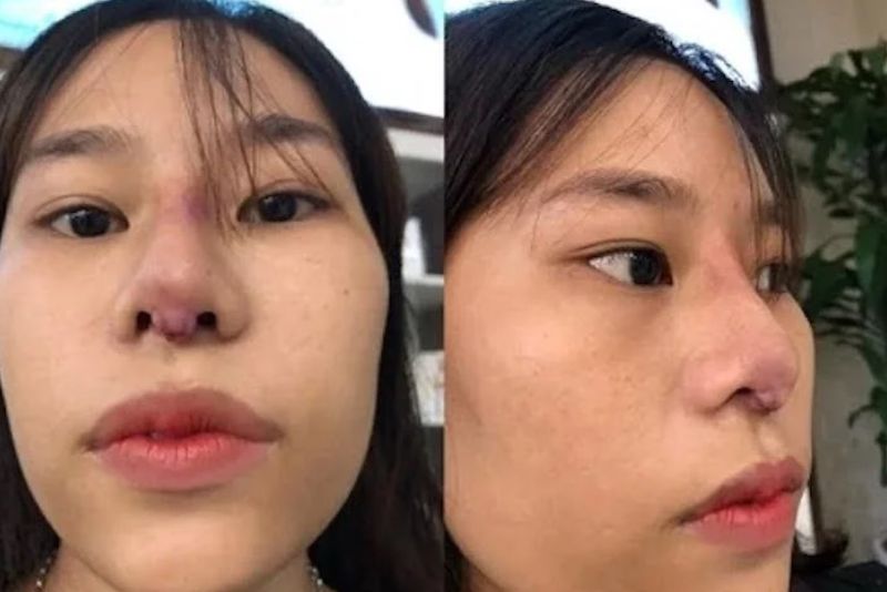 Hậu quả khi nâng mũi cấu trúc giá rẻ