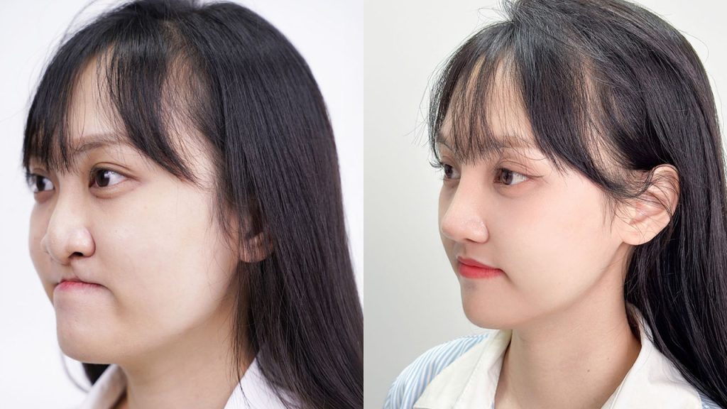 Hành trình “biến hóa” ngoạn mục của cô gái hàm ếch Minh Xuân