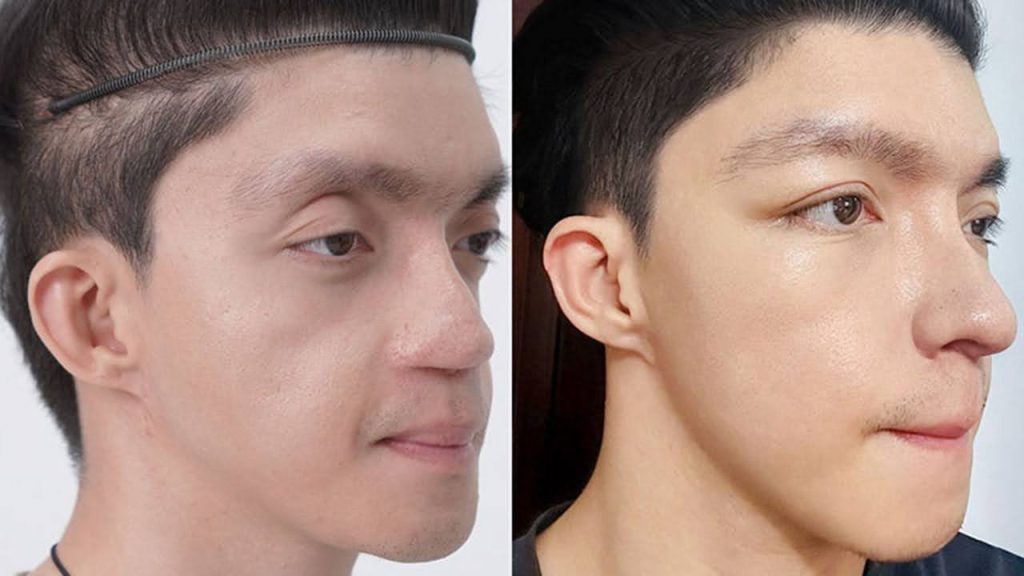 Chàng trai Avatar hóa soái ca sau cuộc đại phẫu thẩm mỹ