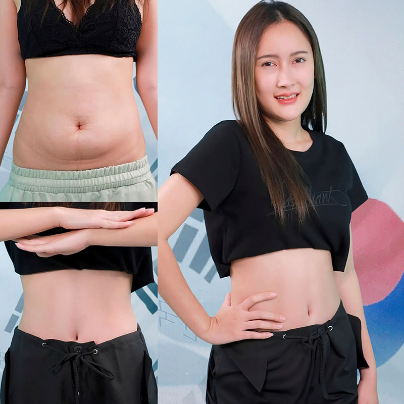 Giảm mỡ bụng nhanh chóng, an toàn