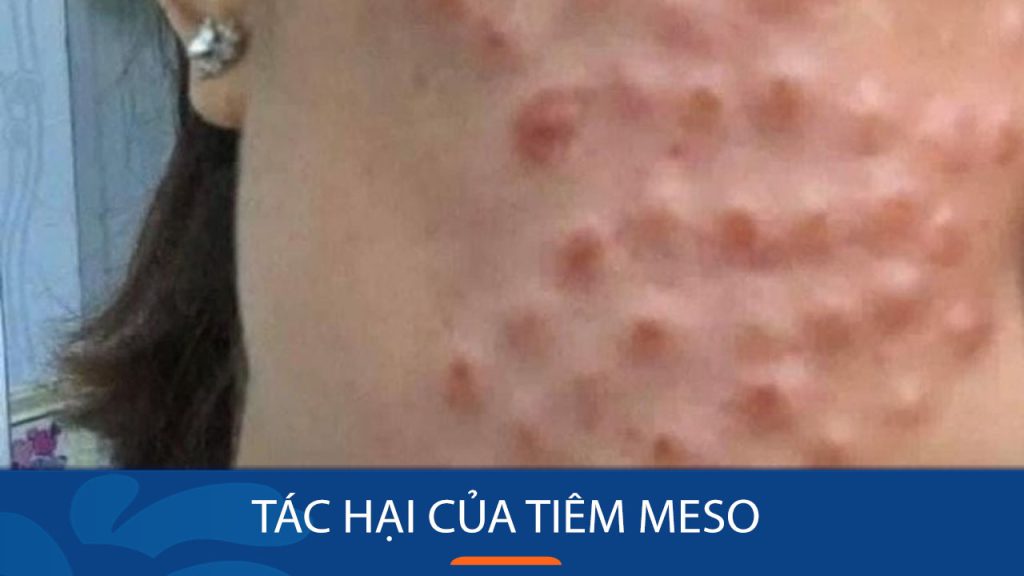 5 Tác hại khi tiêm meso có thể bạn chưa biết