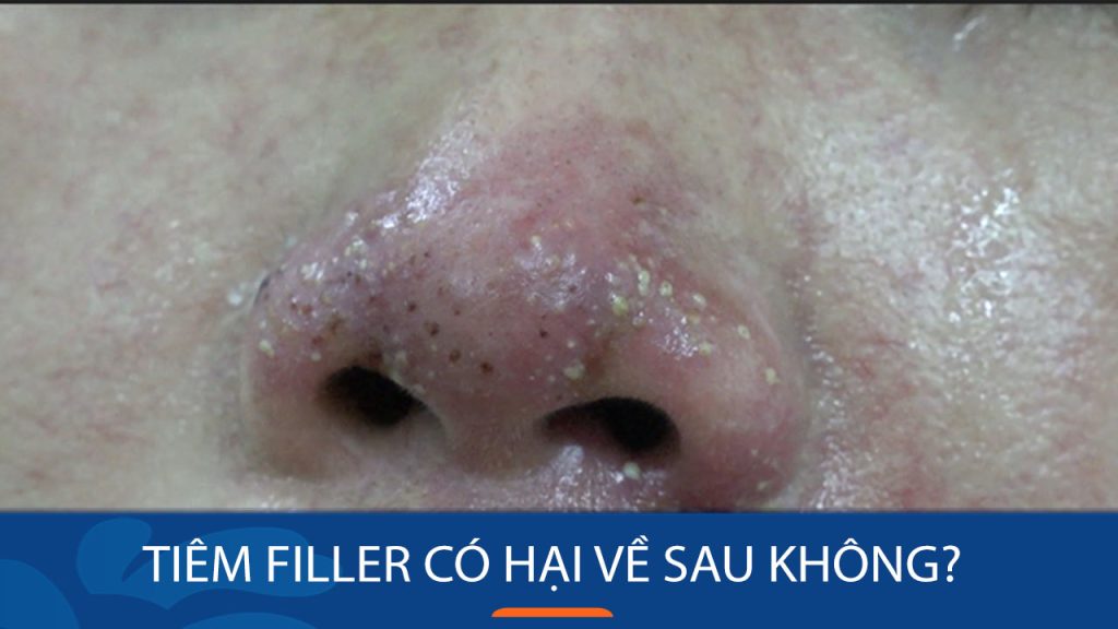 Tiêm filler có hại về sau không? Dấu hiệu và cách xử lý