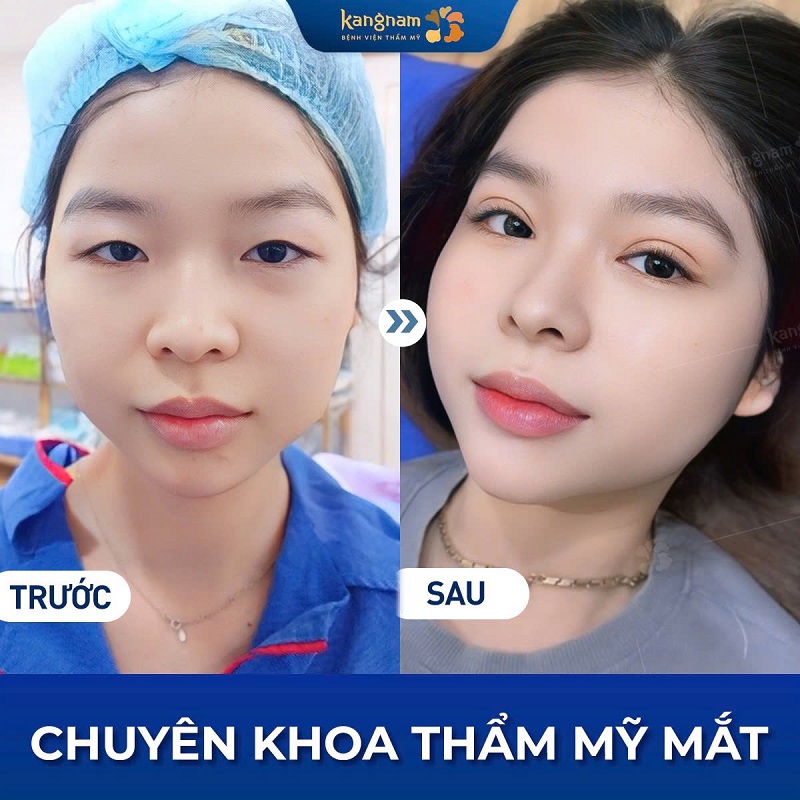 Nếp mí rõ nét, cân đối với khuôn mặt