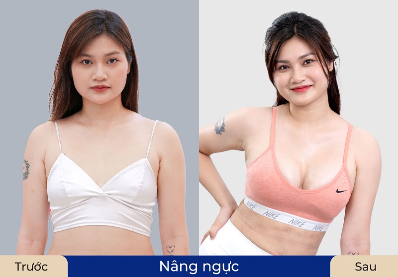 Nâng cấp vòng 1 tại Kangnam với chi phí hợp lý