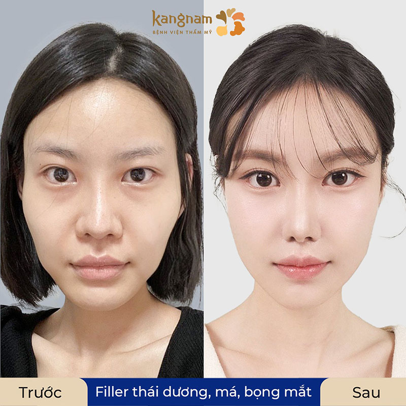 Tiêm filler vào form đẹp sau khoảng 2 - 4 tuần