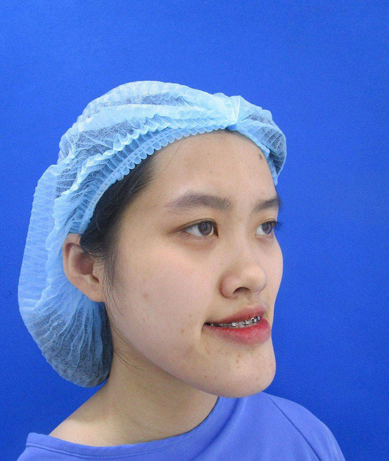 Mai Anh bị hàm móm khá nhiều