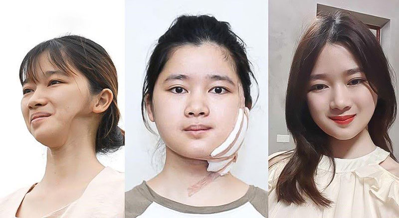 Sự thay đổi của Thu Hường sau khi phẫu thuật Hàm mặt tại BVTM Kangnam