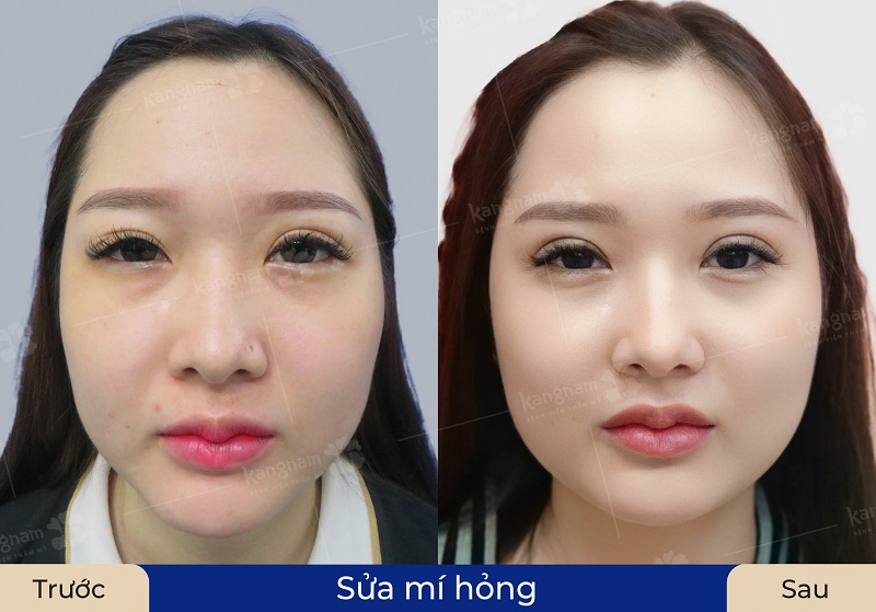 Mí mắt của khách hàng sau sửa đã ổn định và rõ nét hơn