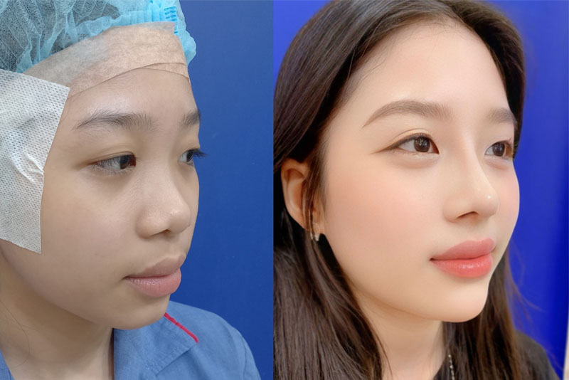 Nâng mũi bọc sụn tai hạn chế biến chứng