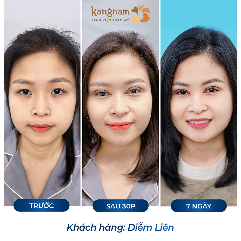 Mí mắt tự nhiên, hết sưng tấy