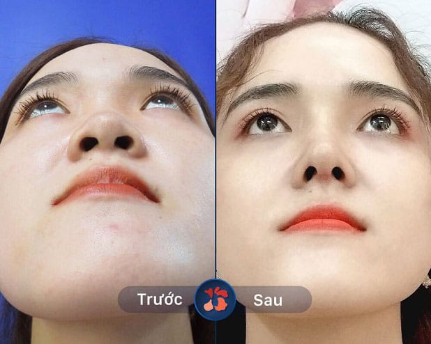 Vùng mũi thường sưng nề do tác động can thiệp vào mô và sụn.