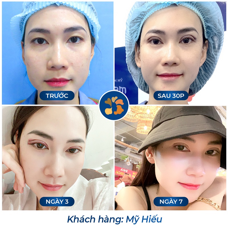 Mí mắt hết sưng tấy, rõ nét và hài hòa hơn
