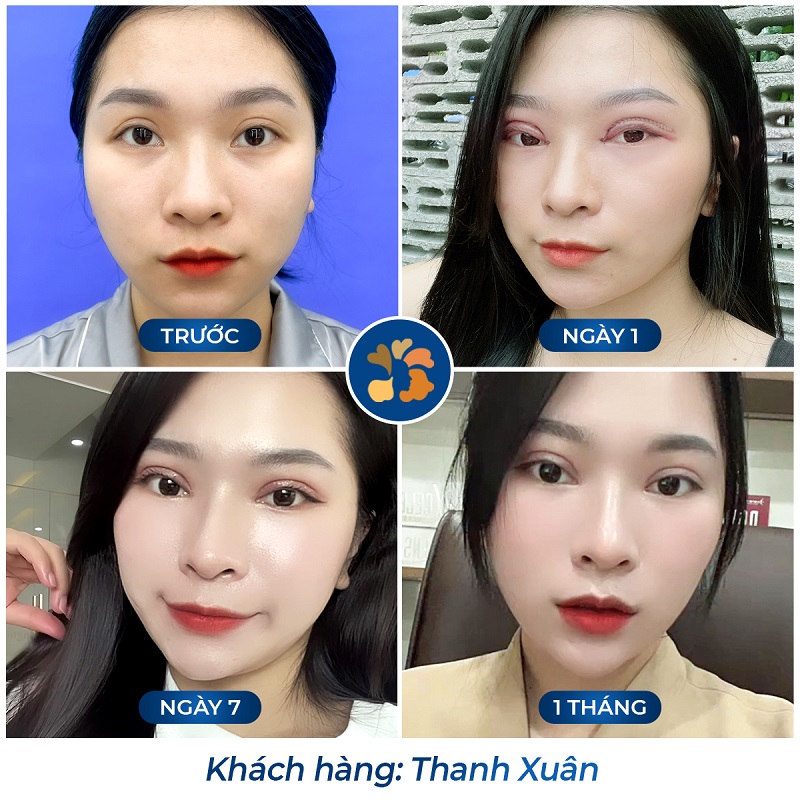 Khách hàng cắt mí tại Kangnam có thời gian phục hồi nhanh
