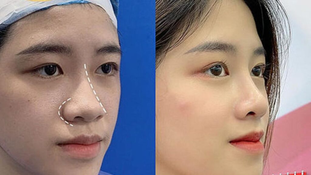 Cắt cánh mũi giá bao nhiêu? Bảng giá chi tiết và mới nhất 2025