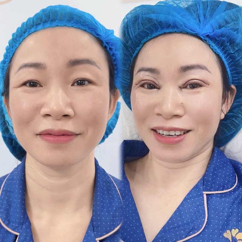 Những người có mí sụp, da dư có thể thực hiện cắt mí