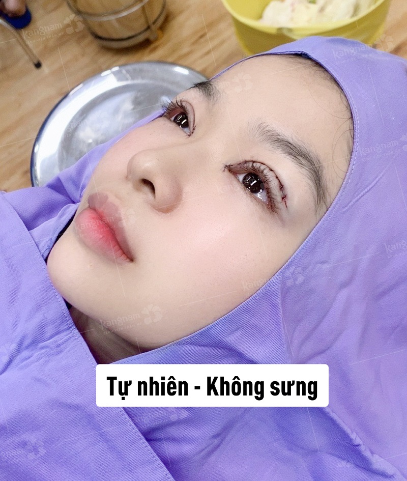 Nếp mí mới tự nhiên, không sưng tấy