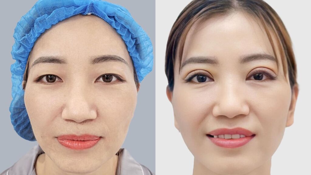 Cắt mí sau bao lâu thì đẹp tự nhiên, quá trình hồi phục nhanh