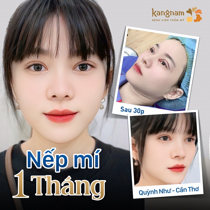 Sau 1 tháng nếp mí đã vào form
