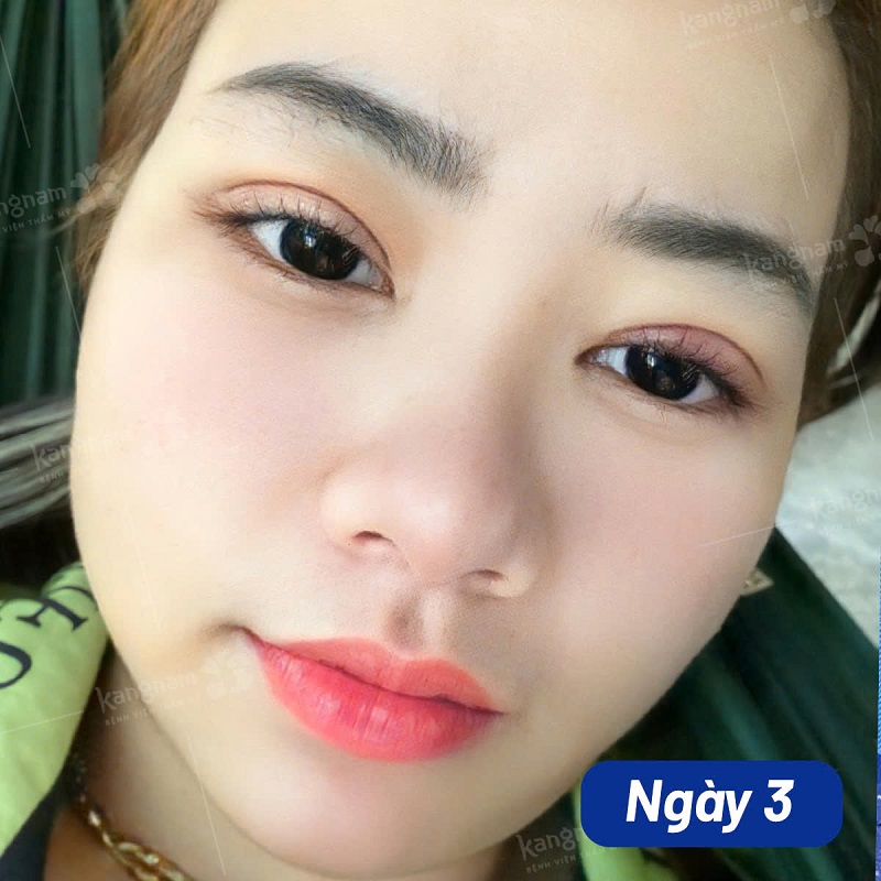 Những ngày đầu mí mắt vẫn còn sưng