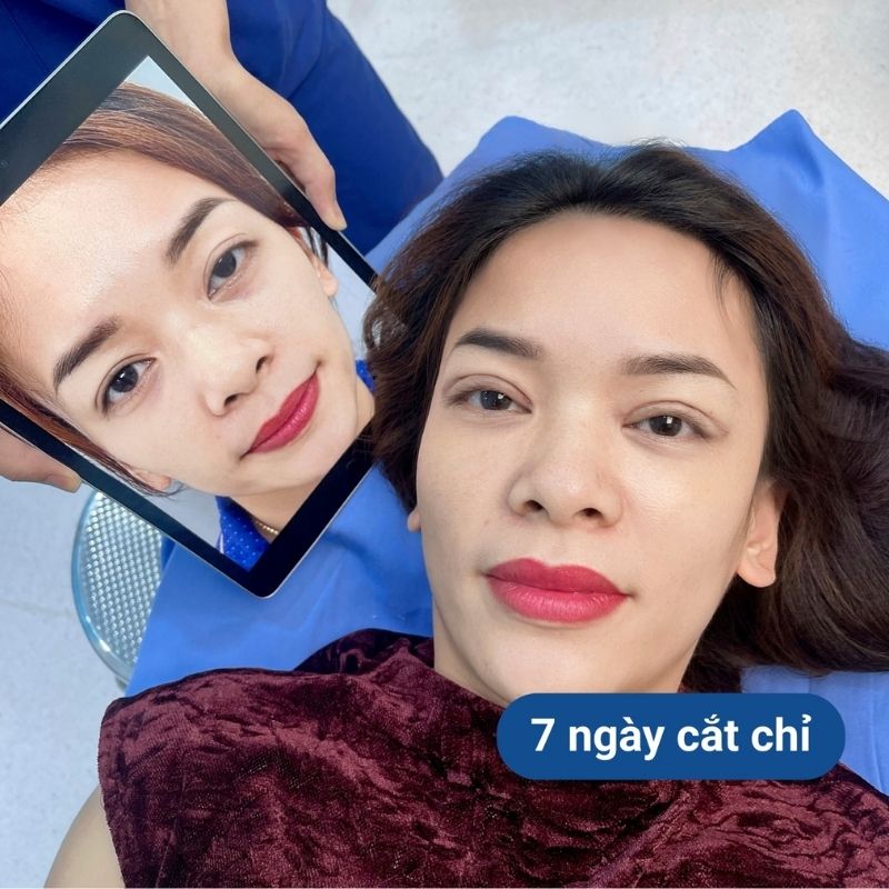 Nếp mí ổn định, không sưng