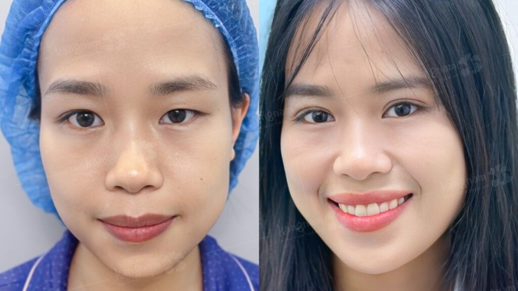 Cắt mí mắt bao lâu thì lành? Cách chăm sóc giúp nếp mí nhanh lành sau cắt mí