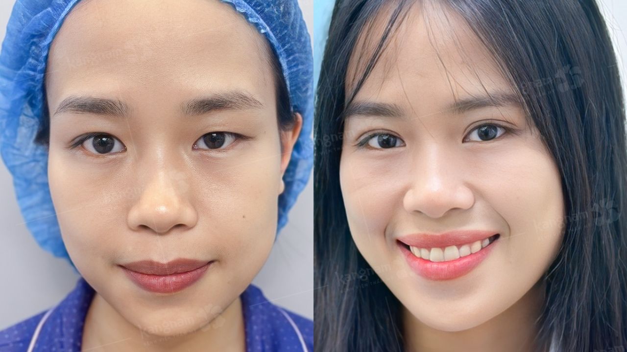 Cắt mí mắt bao lâu thì lành? Cách chăm sóc giúp nếp mí nhanh lành sau cắt mí