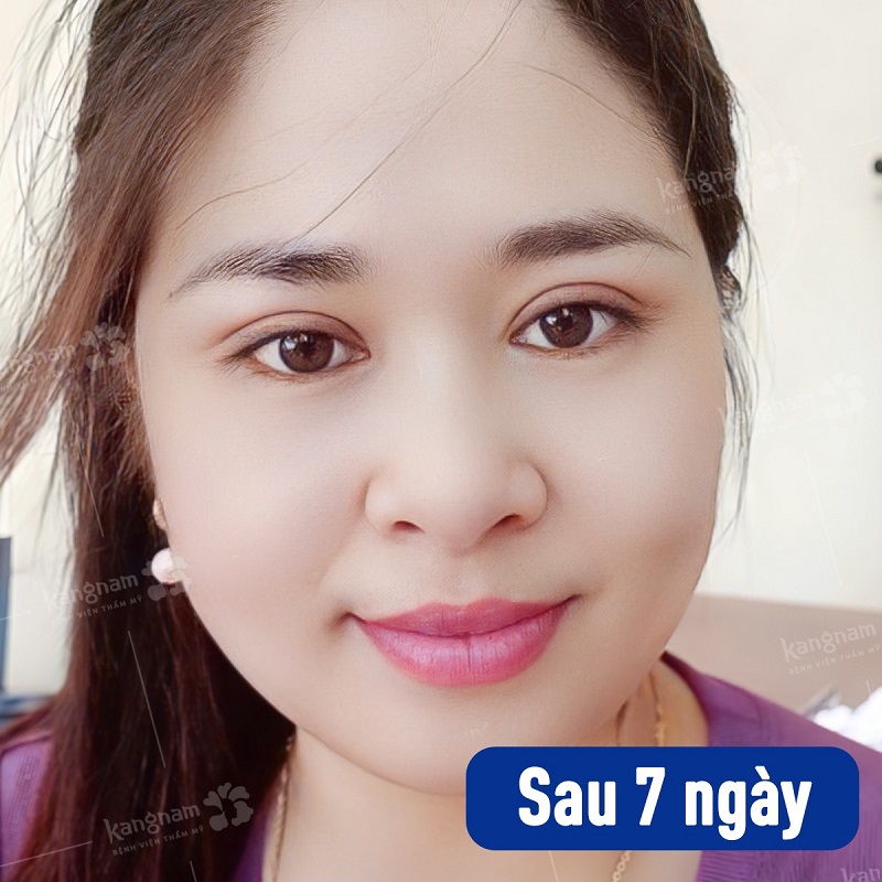 Sau vài ngày cắt mí tình trạng bầm tím sẽ giảm dần