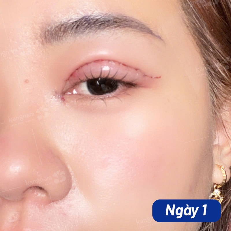 Kỹ thuật cắt mí hiện đại sẽ giảm thiểu được nguy cơ sưng bầm